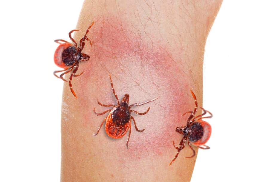 Southern Tick-Associated Rash Illness