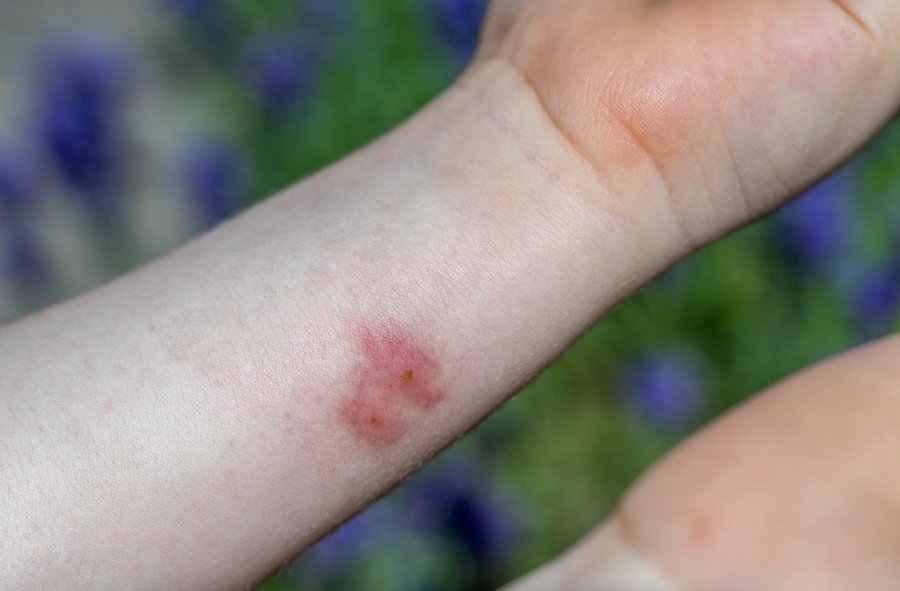 Flea Bites On Kid Hand